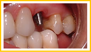 Dental-Implants-before