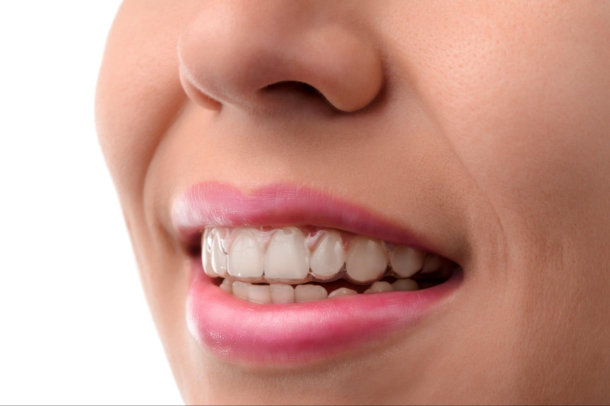 A women with with barely noticeable Invisalign aligners on the upper teeth smiles.