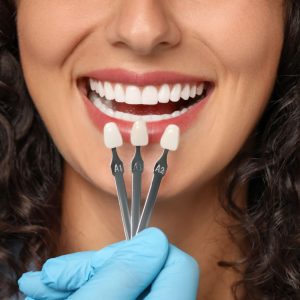 Close-up of a patient smiling while holding three different tooth shade swatches near their teeth for veneer colour matching.