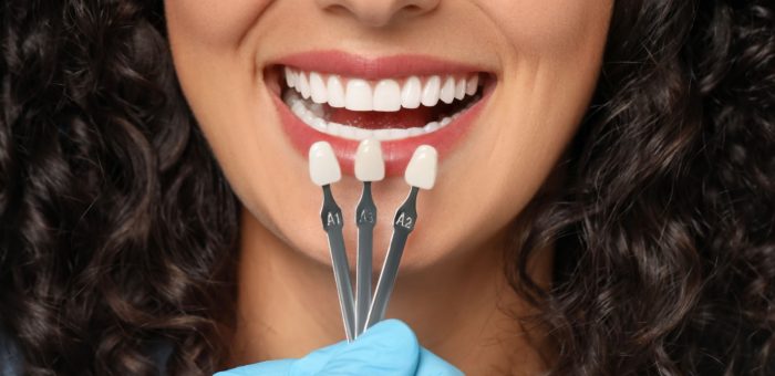 Close-up of a patient smiling while holding three different tooth shade swatches near their teeth for veneer colour matching.