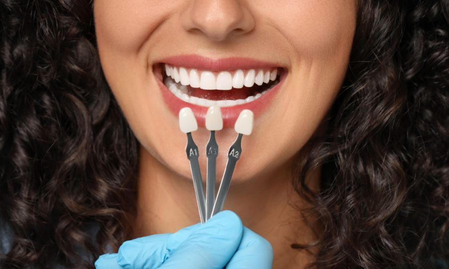 Close-up of a patient smiling while holding three different tooth shade swatches near their teeth for veneer colour matching.