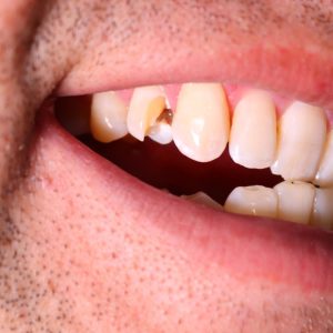 Close-up of a chipped tooth on a person's front teeth.