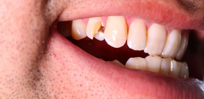 Close-up of a chipped tooth on a person's front teeth.