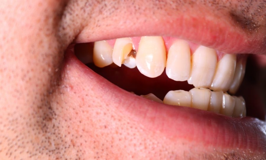 Close-up of a chipped tooth on a person's front teeth.